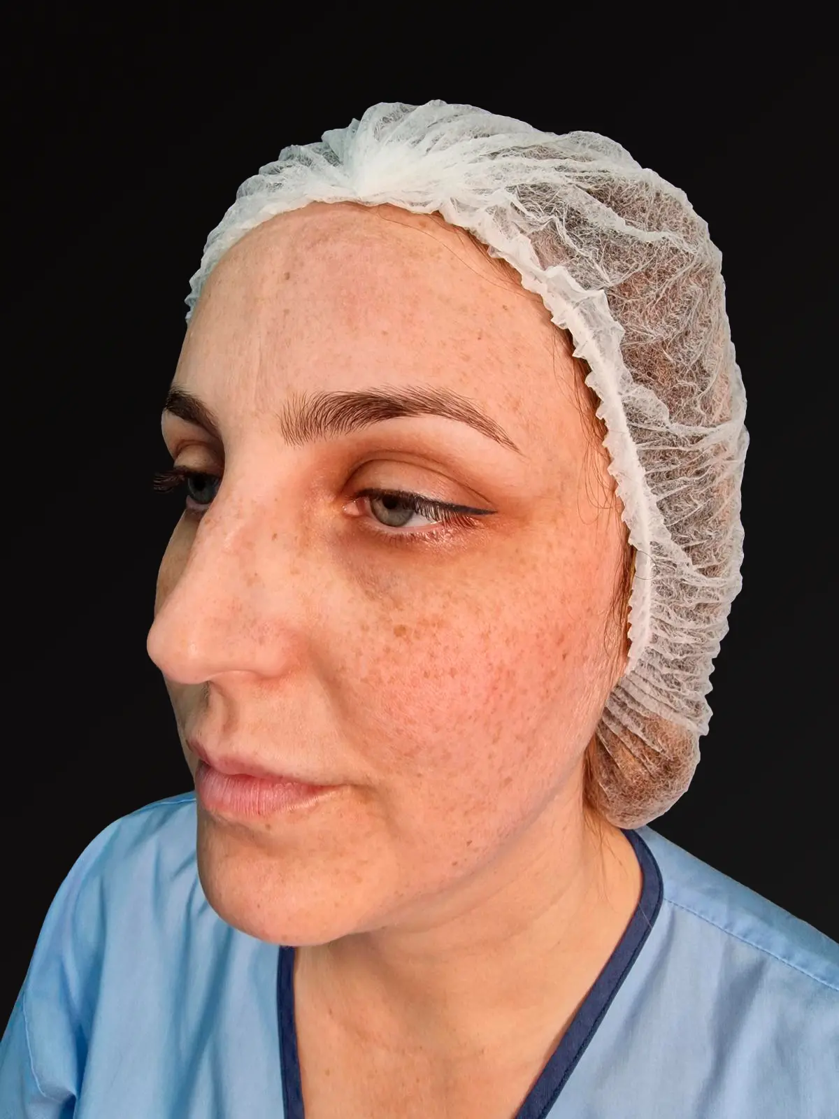 'Estado antes de la rinoplastia - Caso 2'