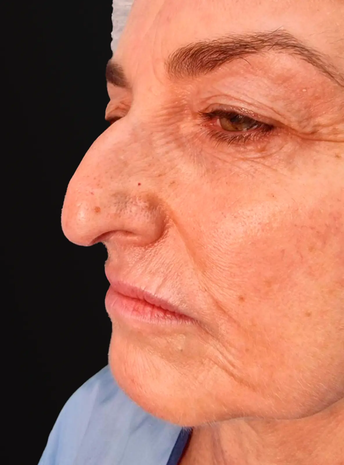 'Estado antes de la rinoplastia - Caso 3'