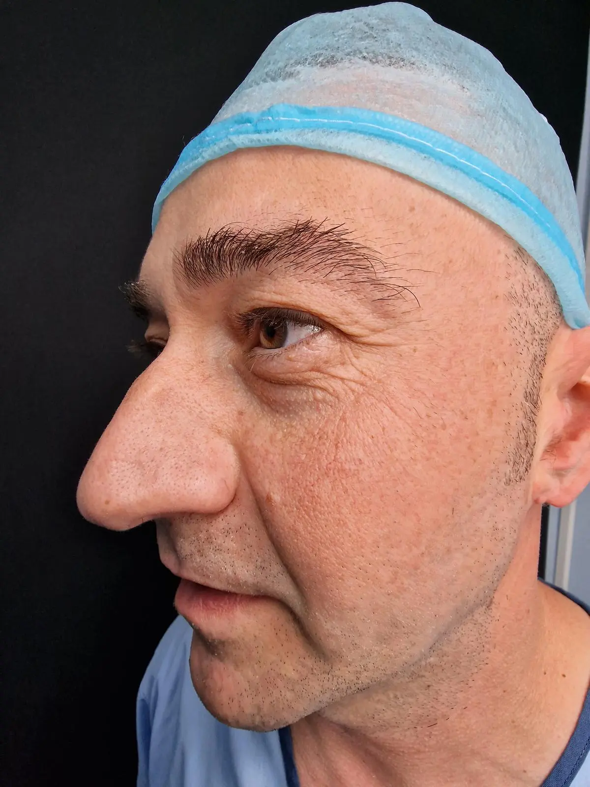 'Estado antes de la rinoplastia - Caso 1'