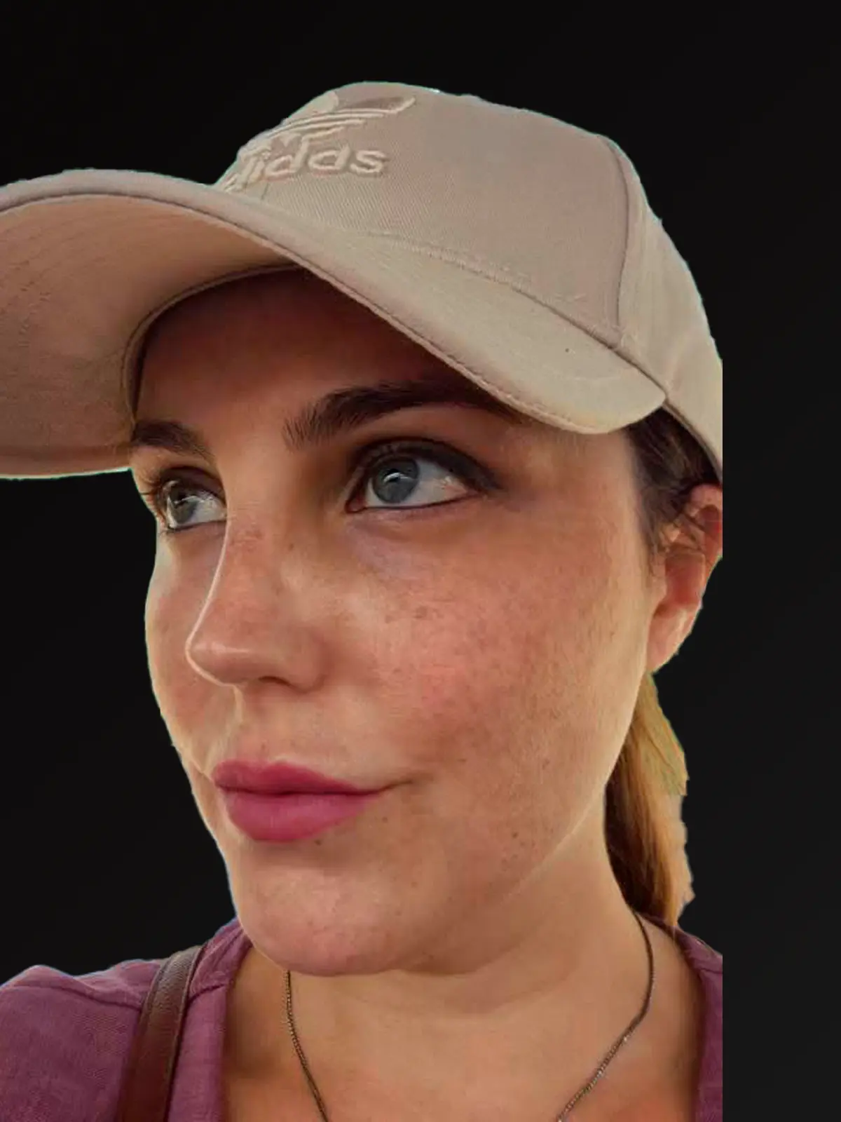 'Resultado después de la rinoplastia - Caso 2'