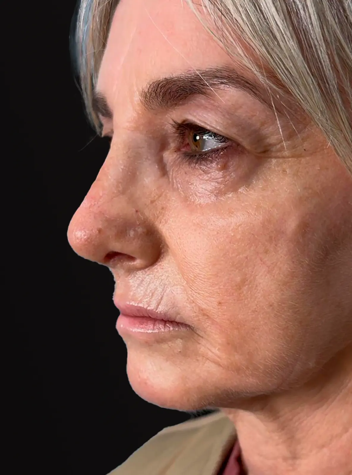 'Resultado después de la rinoplastia - Caso 3'