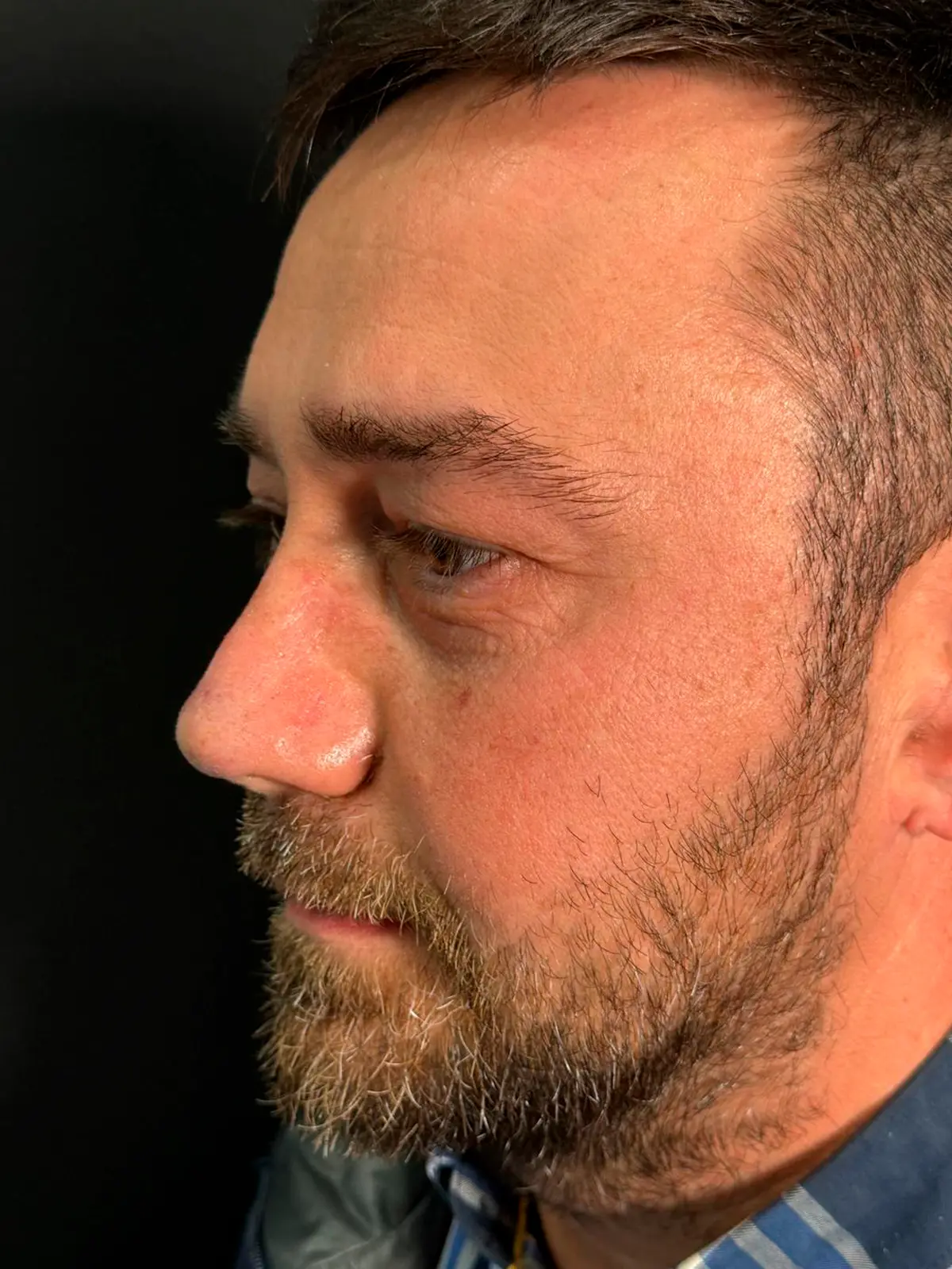 'Resultado después de la rinoplastia - Caso 1'